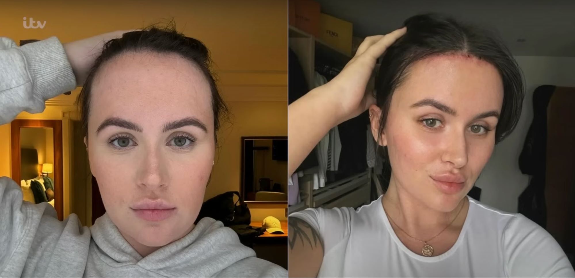 Beth Halseys Forehead Reduction How It Changed Her Life