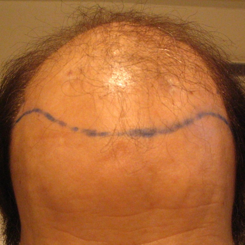5000 Graft Hair Transplant Coverage Costs Results