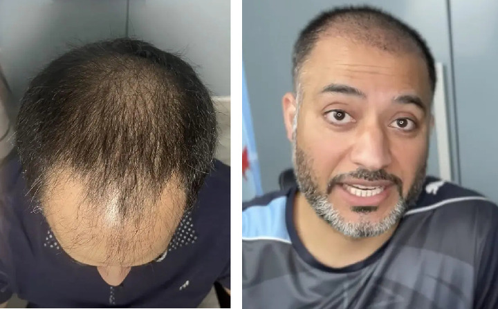 Hair Transplant After Month Photos Results Side Effects