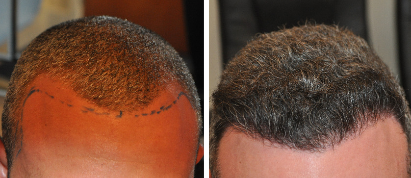 Grafts Hair Transplant Coverage Costs Results