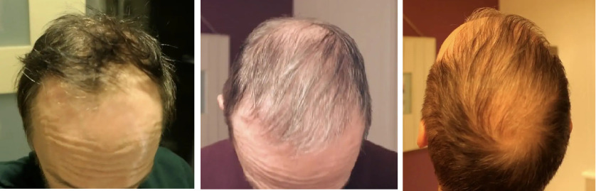 Hair Transplant After 4 Months Photos Results Side Effects