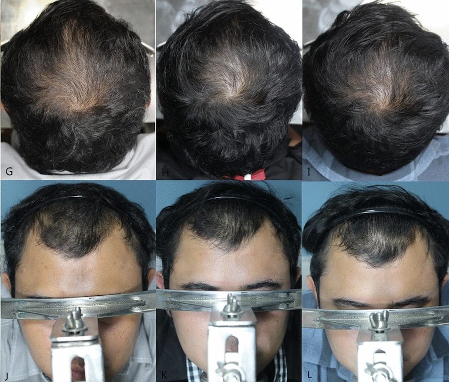 Minoxidil Before And After Photos Results Wimpole Clinic