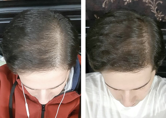 Rosemary Oil Before And After Hair Loss Results Wimpole Clinic