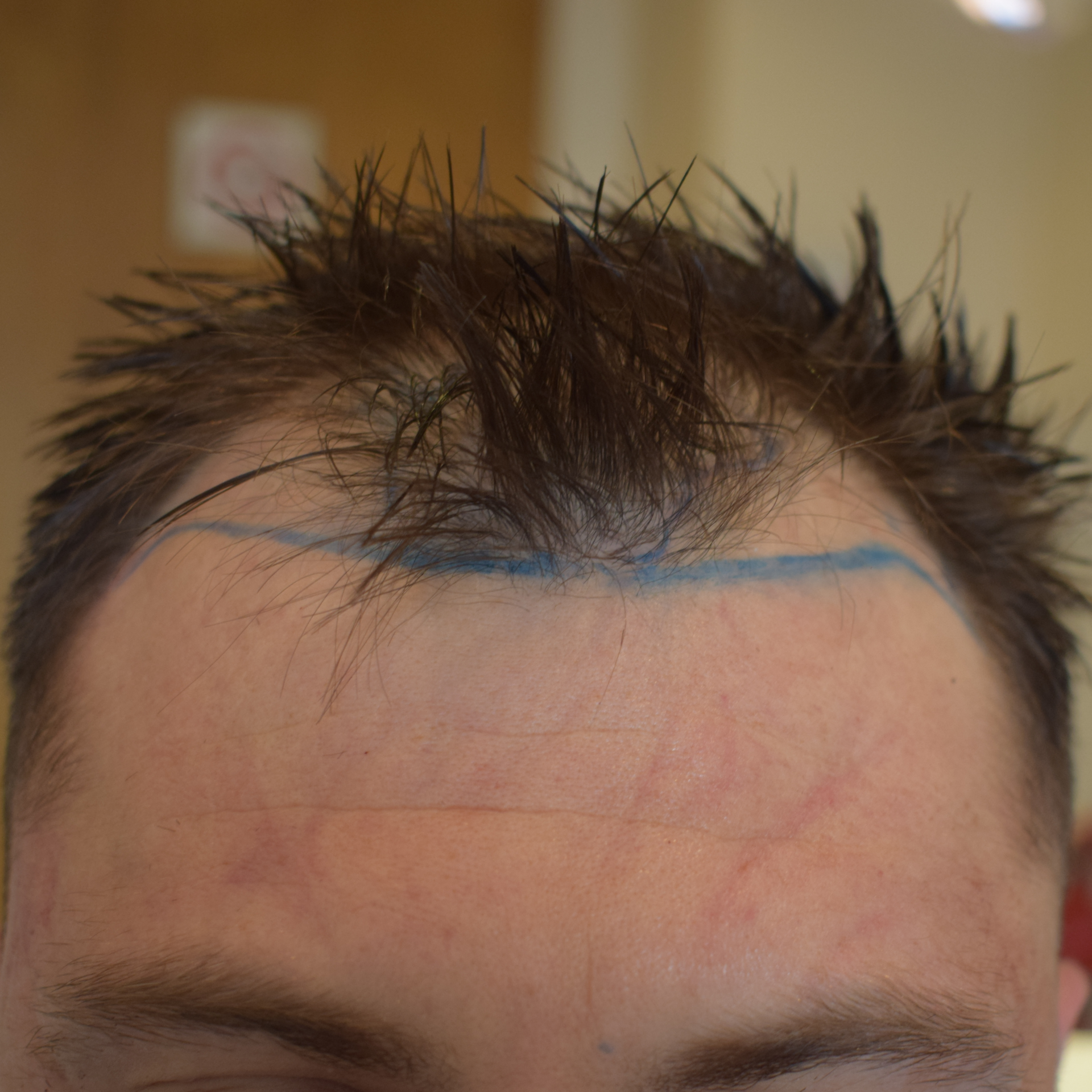 Hairline Transplant, Wimpole Clinic