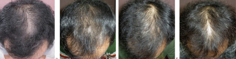 Results of 6 years of Finasteride treatment