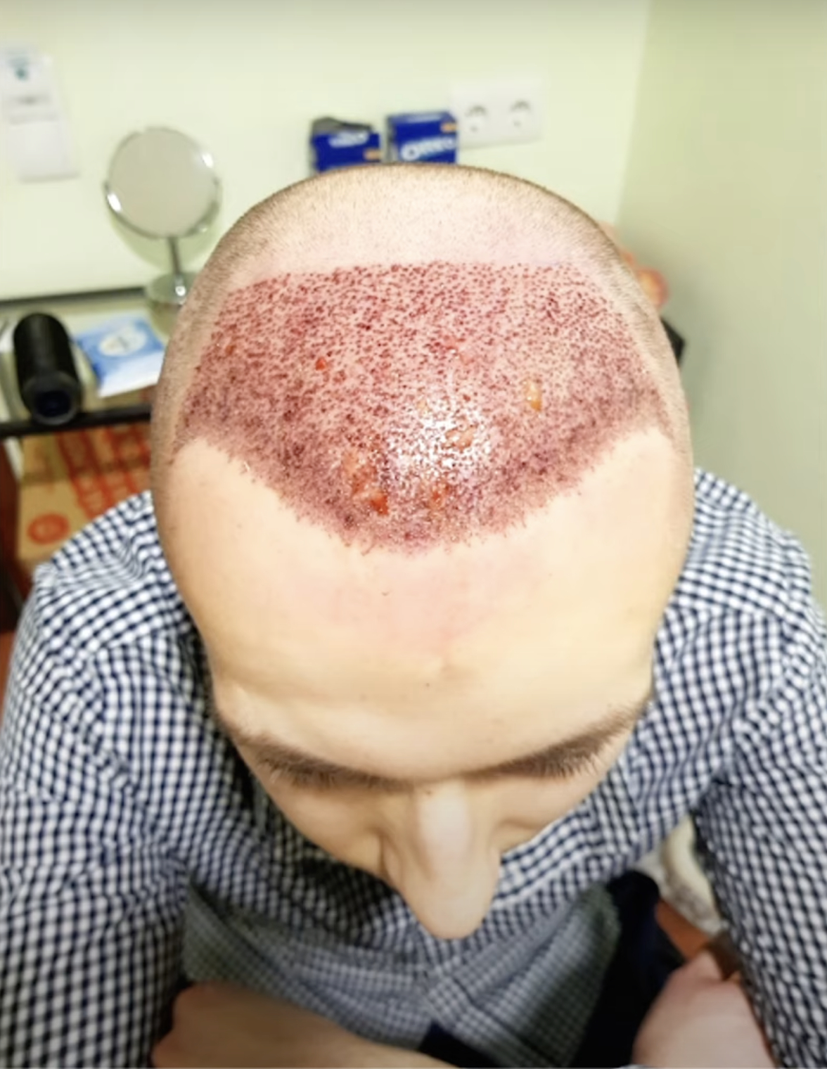 Immediately after FUE surgery