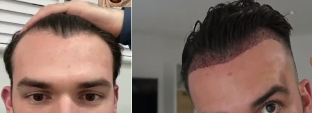 Before and 1 day after hair transplant procedure