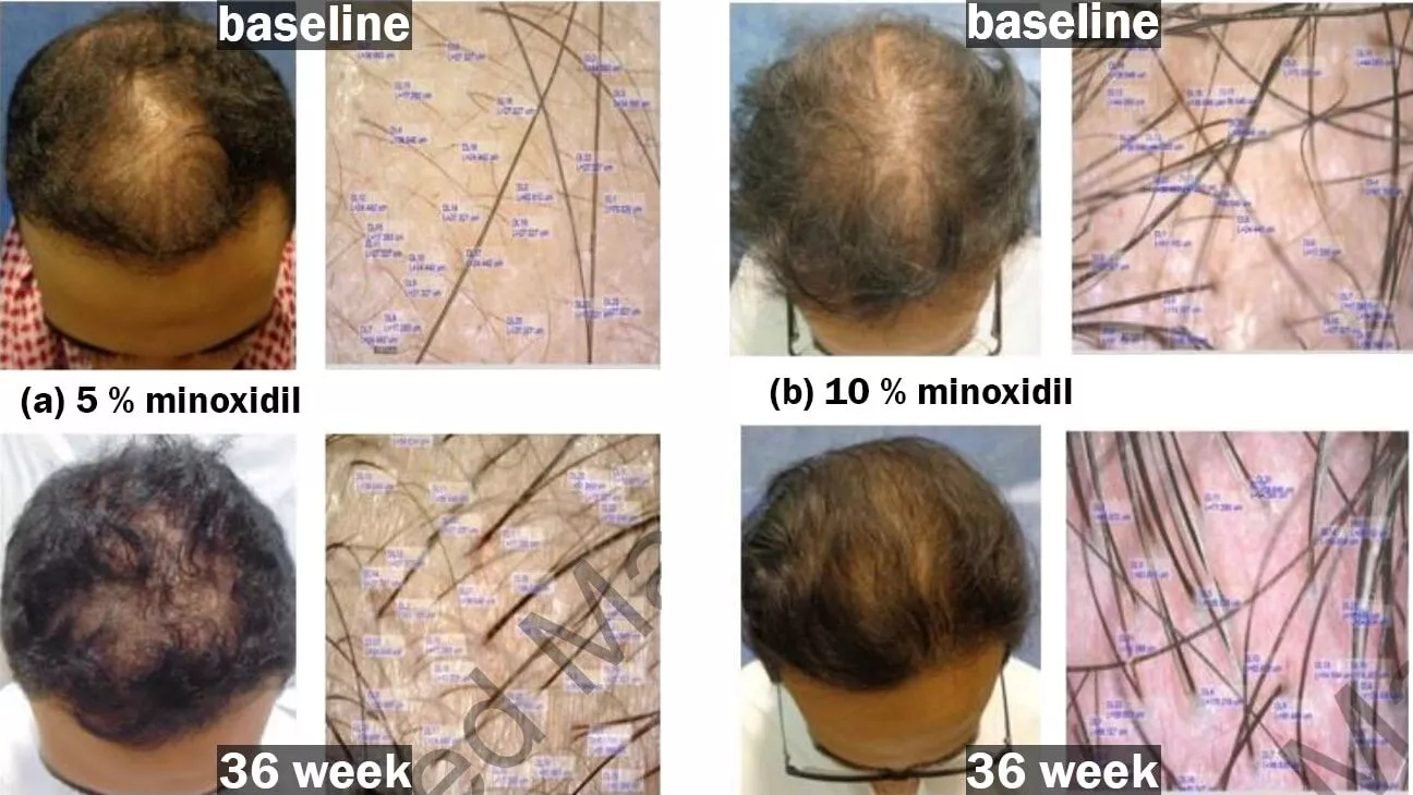 before and after 10% Minoxidil results