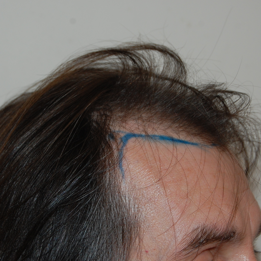 Norwood Stage 4 Photos, Treatments, Results Wimpole Clinic