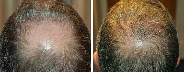 How Much Does A Crown Hair Transplant Cost?