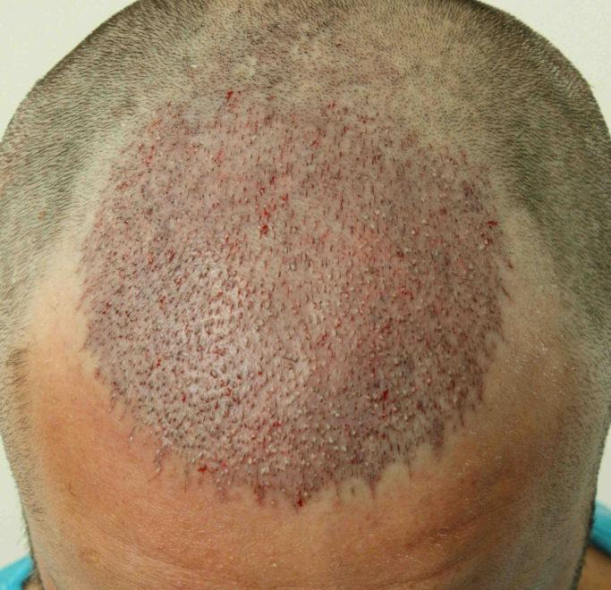 Hair Transplant After 14 Days: Photos, Results, Side Effects, Wimpole Clinic