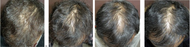 Results from 9 years of Finasteride treatment for hair loss