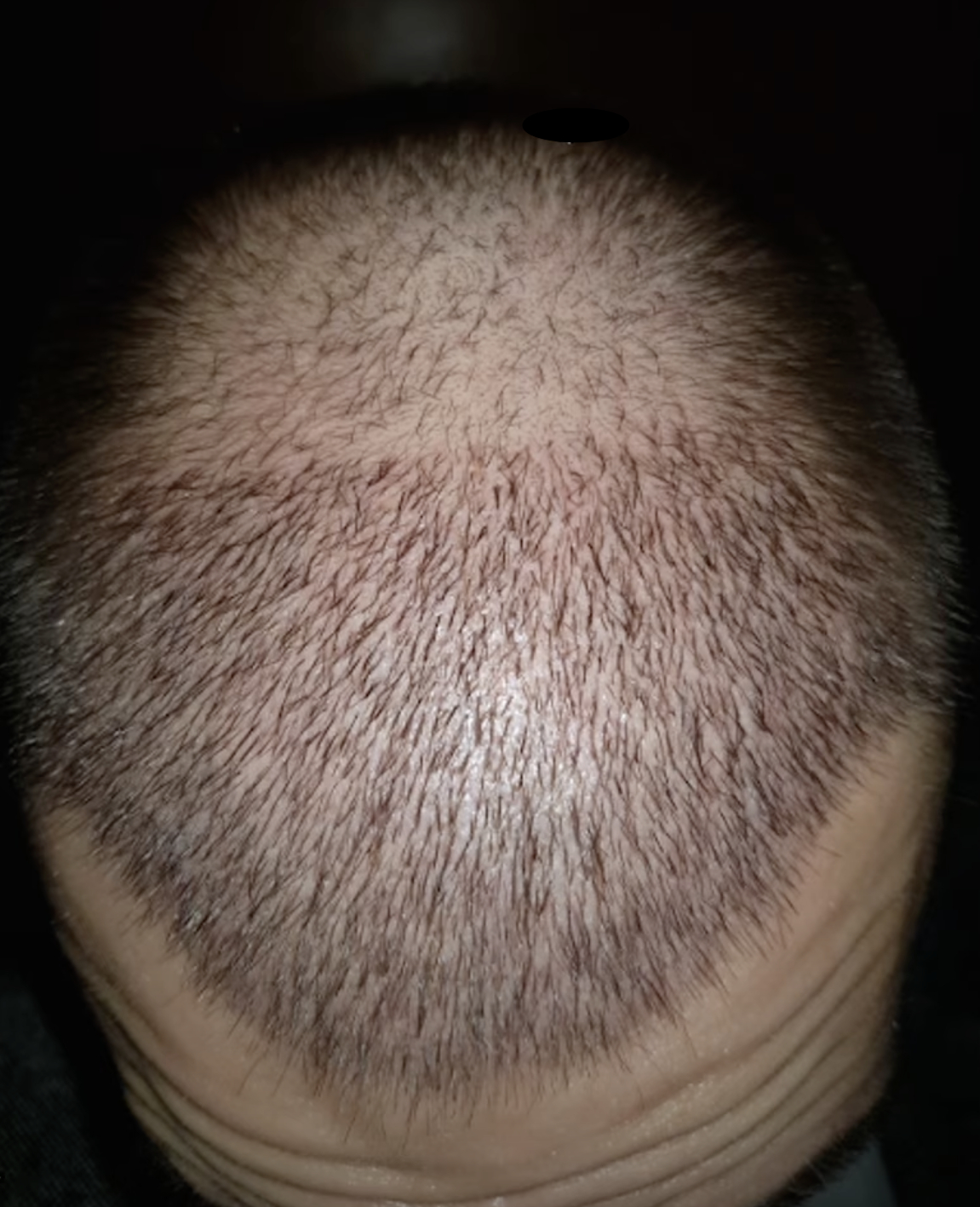 20 days after FUE hair transplant surgery