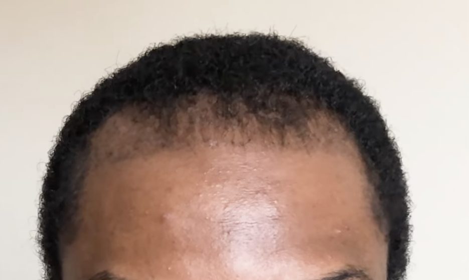 2 months after afro hair transplant