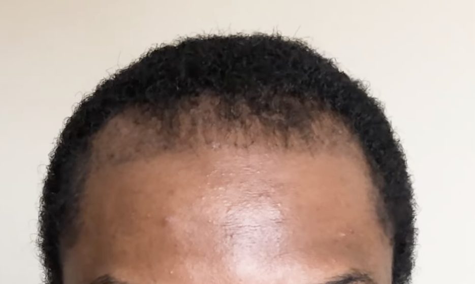 Hair Transplant Growth Timeline  Day By Day Recovery Photos