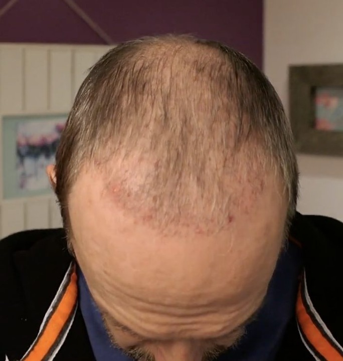 Hair Transplant After 2 Months Photos, Results, Side Effects