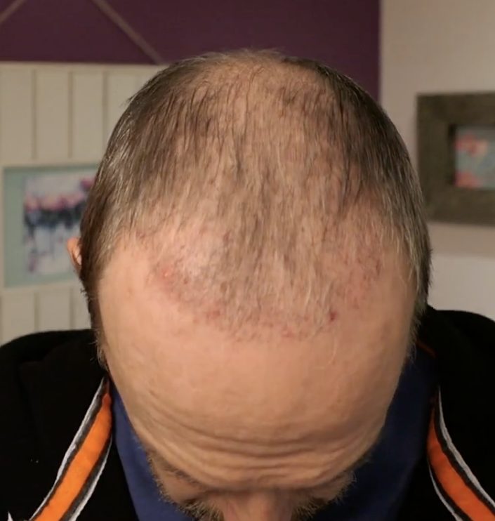 2 months after hair transplant 1