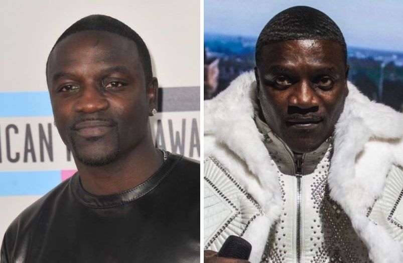 Akon hair transplant