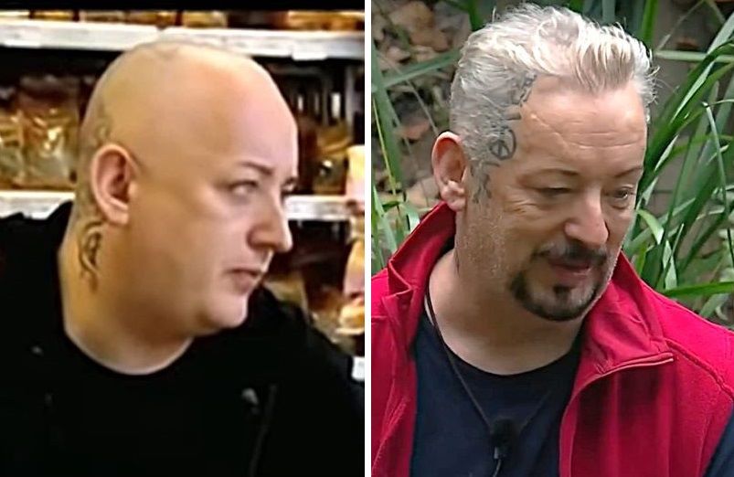 Boy George hair transplant