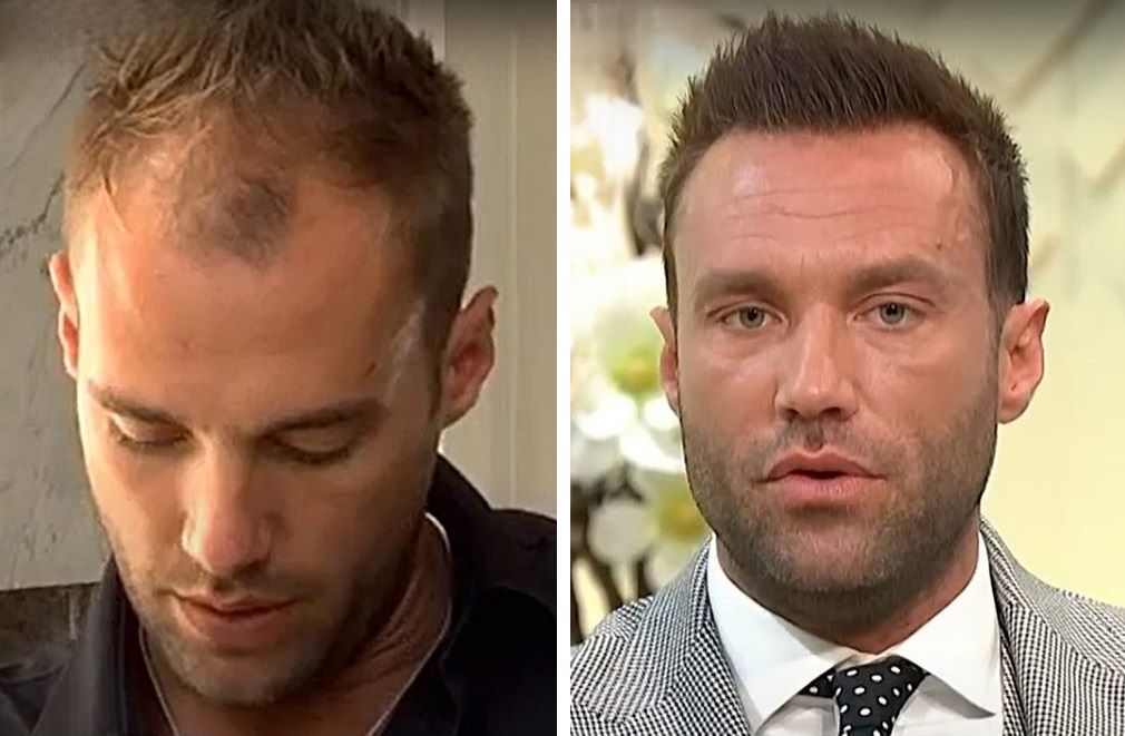 Calum Best hair transplant