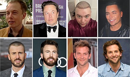 Celebrity Hair Transplants Before & After