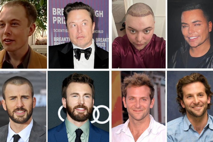 Celebrity Hair Transplants Before & After