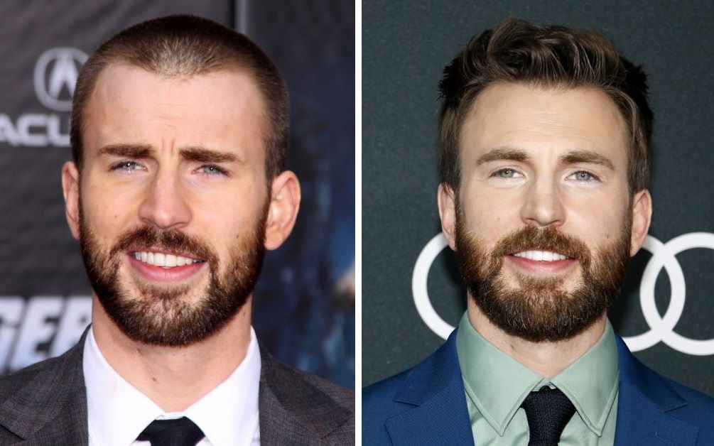 Chris Evans hair transplant