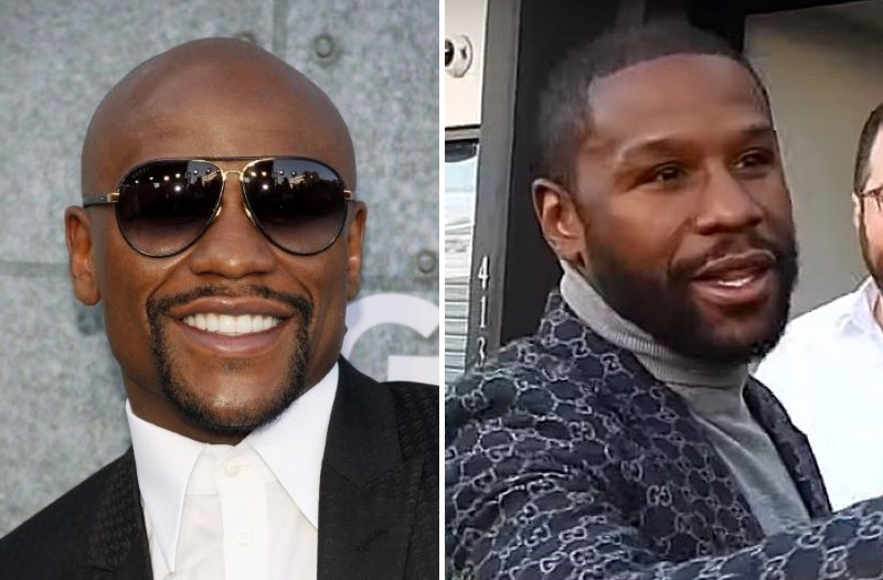 Floyd Mayweather hair transplant