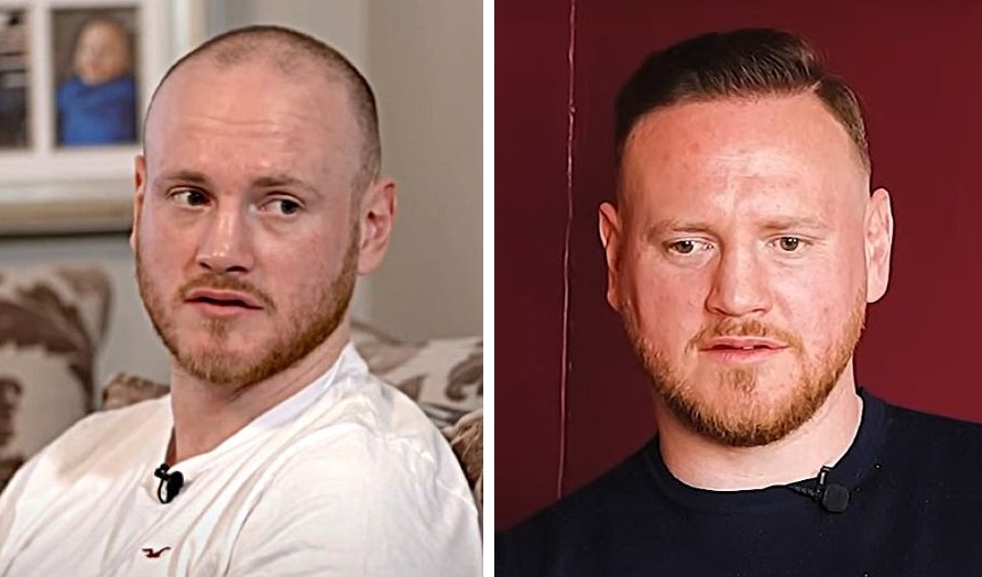 George Groves hair transplant