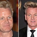 Gordon Ramsay Hair Transplant: Everything You Need To Know