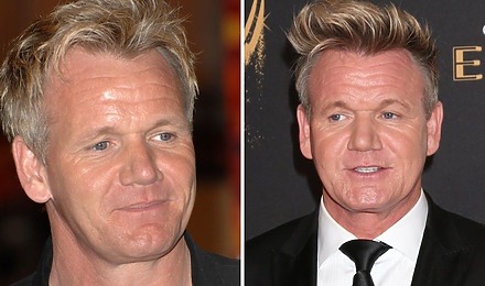 Gordon Ramsay Hair Transplant