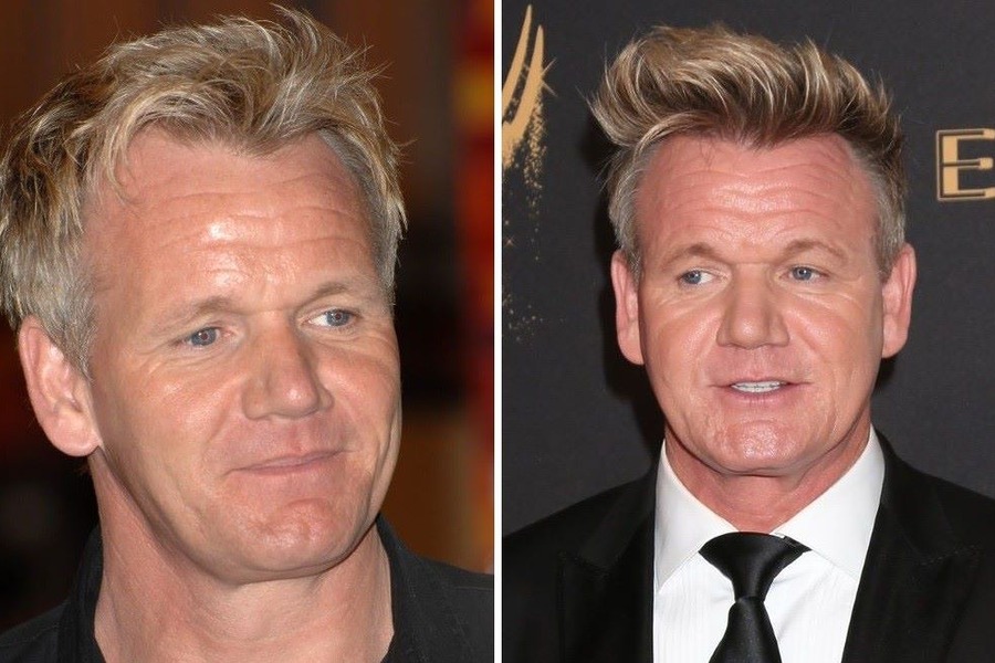 Gordon Ramsay Hair Transplant