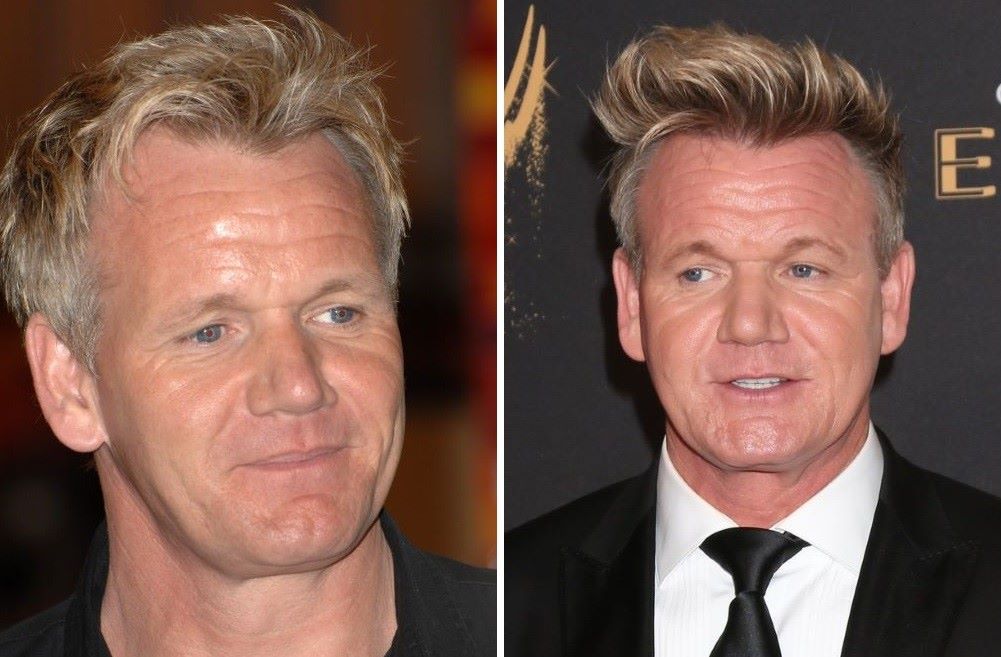 Gordon Ramsay hair transplant