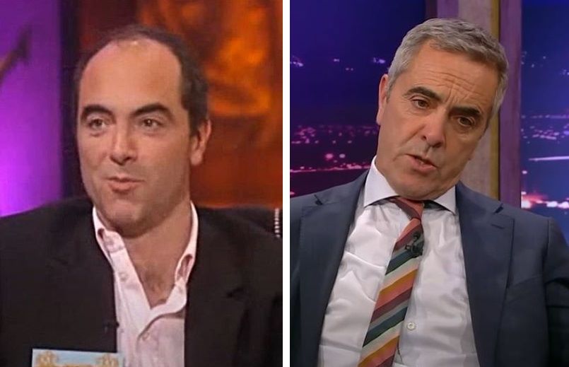 James Nesbitt hair transplant