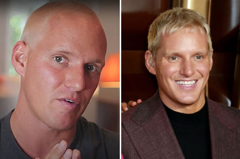 Jamie Laing hair transplant