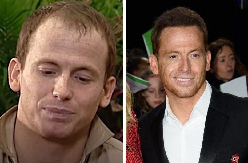 Joe Swash hair transplant