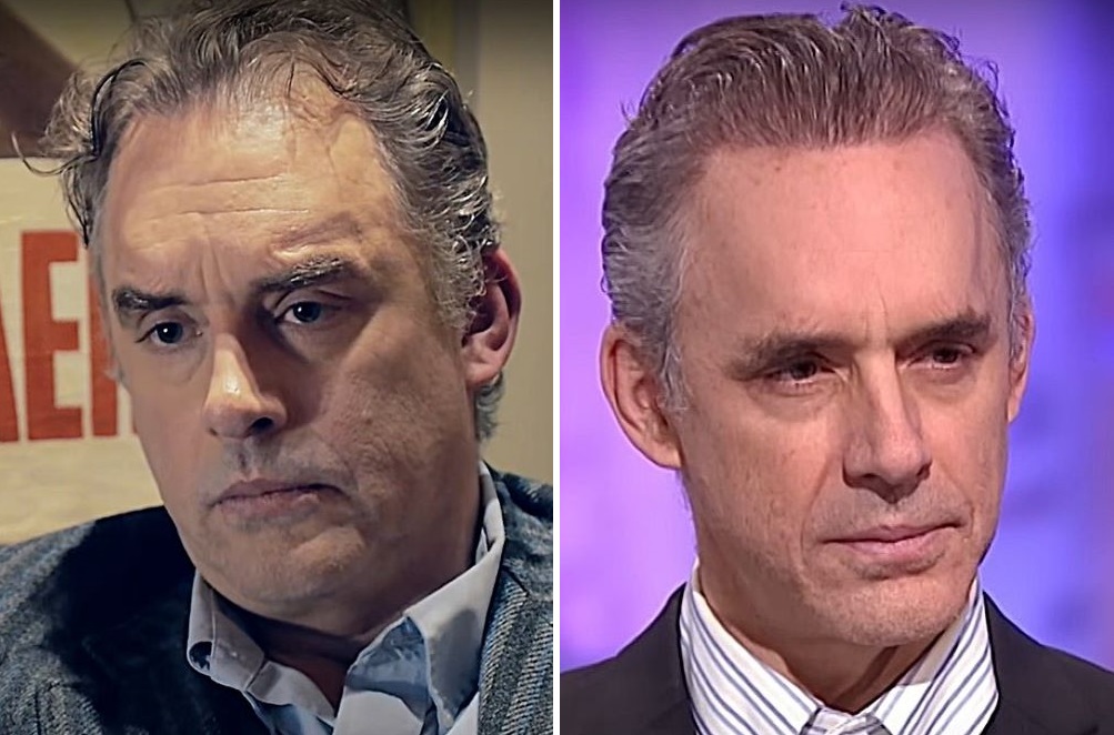 Jordan Peterson hair transplant