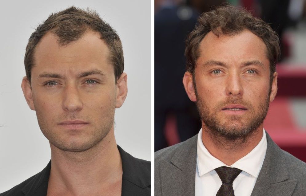 Jude Law hair transplant