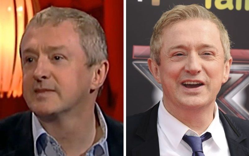 Louis Walsh hair transplant