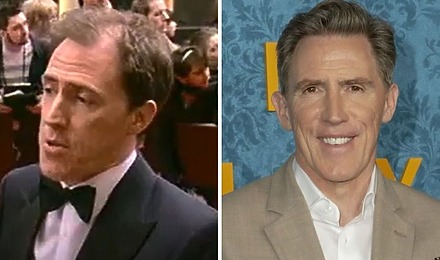 Rob Brydon Hair Transplant