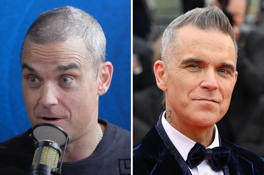 Robbie Williams hair transplant