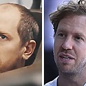 Sebastian Vettel Hair Transplant: Everything You Need To Know