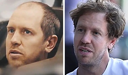 Sebastian Vettel Hair Transplant