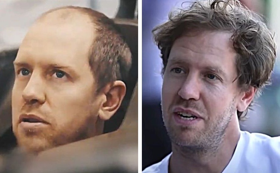 Sebastian Vettel Hair Transplant