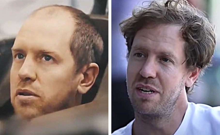 Sebastian Vettel hair transplant