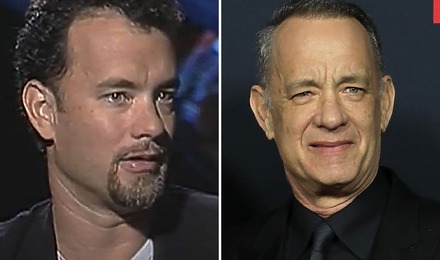 Tom Hanks Hair Transplant