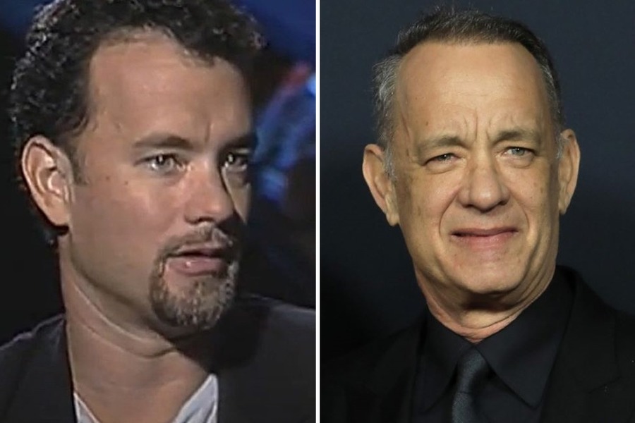 Tom Hanks Hair Transplant