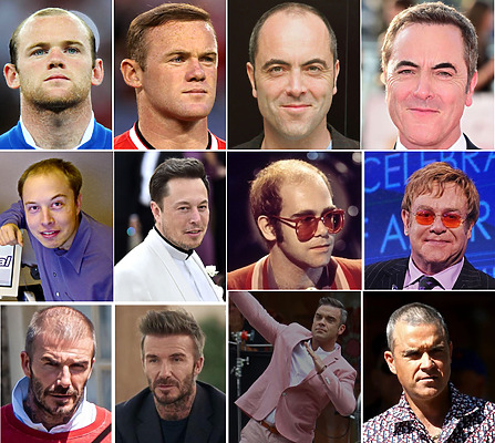 celebrity hair transplants featured image