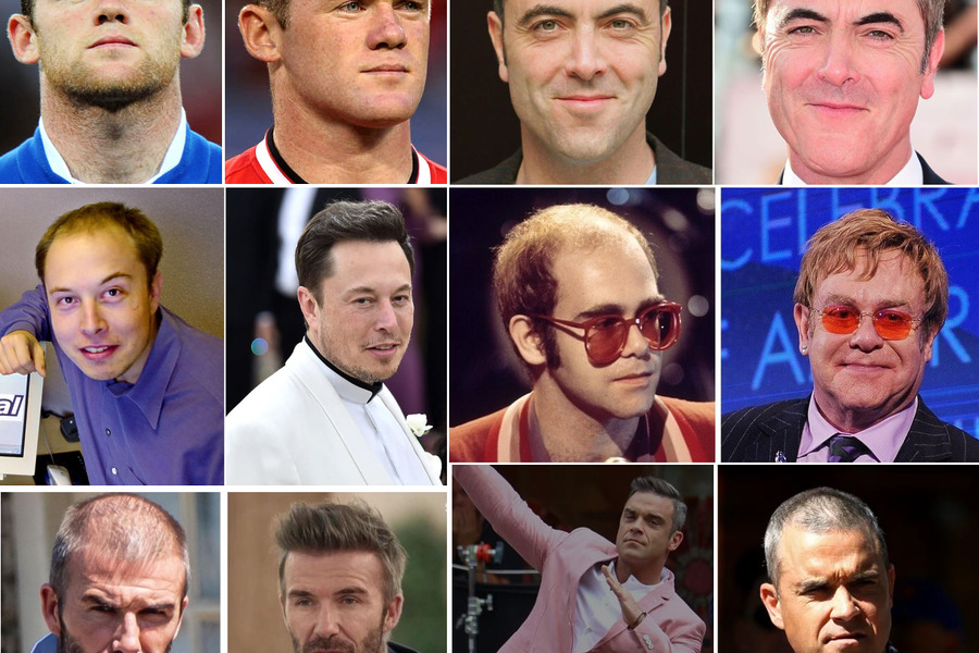 Celebrity Hair Transplants Featured Image