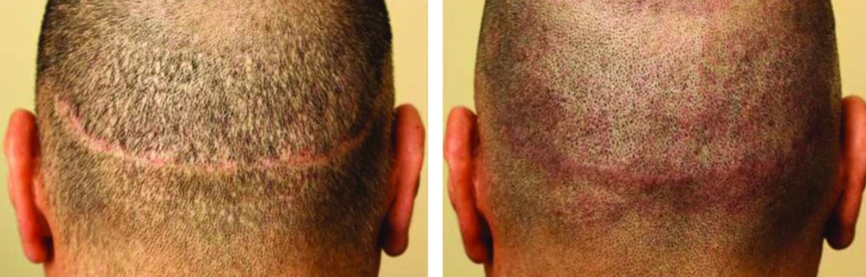 Before and after scalp micropigmentation to cover up FUT hair transplant scar
